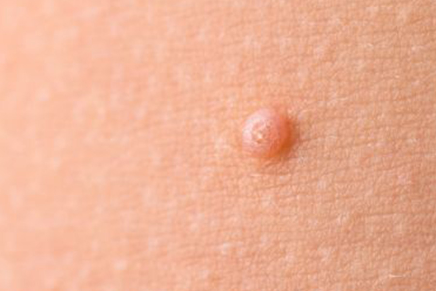 MOLUSCUM CONTAGIOSOS