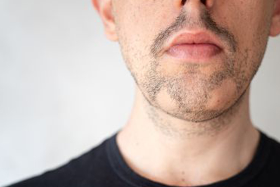 ALOPECIA AREATA