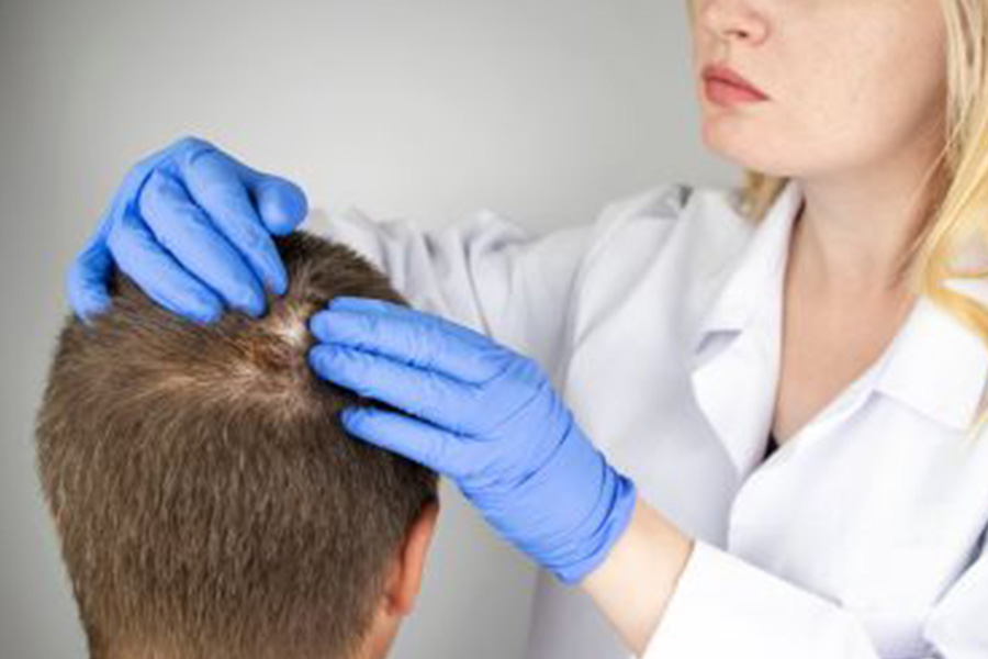 ALOPECIA